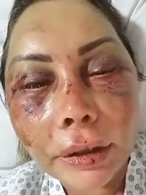 {'nm_midia_inter_thumb1':'https://midias.jb.com.br/_midias/jpg/2019/02/19/60x59/1_espancamento_256206-257164.jpg', 'id_midia_tipo':'2', 'id_tetag_galer':'', 'id_midia':'5c6c6bd91b6d0', 'cd_midia':257175, 'ds_midia_link': 'https://midias.jb.com.br/_midias/jpg/2019/02/19/300x400/1_espancamento_256206-257164.jpg', 'ds_midia': 'Elaine ficou chocada quando se viu no espelho e entendeu a gravidade do que aconteceu

', 'ds_midia_credi': 'Reprodu&ccedil;&atilde;o', 'ds_midia_titlo': 'Elaine ficou chocada quando se viu no espelho e entendeu a gravidade do que aconteceu

', 'cd_tetag': '1', 'cd_midia_w': '300', 'cd_midia_h': '400', 'align': 'Left'}