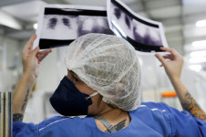 M&eacute;dica compara duas radiografias de t&oacute;rax diferentes de um paciente em Guarulhos, SP